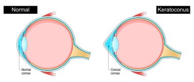 Keratoconus. Göz hastalığı. Kornea incelmesi. İlerleyen göz hastalıkları. Astigmatizm. Düzensiz kornea. Şematik şema. Ayrıntılı vektör illüstrasyonu