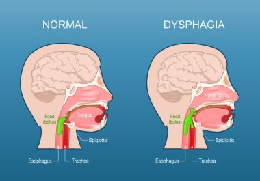 Disfaji. Yutkunma zorluğu. Özofagus disfajisi. Aspirasyon riski. İnsan kafasının Esophagus, Trakea, Burun boşluğu, Dil, Epiglottis ve Besin Bolusu ile çapraz kesimi. Sağlıklı ve sağlıksız insanlar yutkunmakta güçlük çekiyorlar.