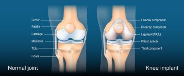 Diz eklemi ameliyatı. Diz eklemi değişimi. Normal eklem ve Toplam Diz implantı anatomisi. Ayrıntılı vektör posteri. İzometrik düz çizim. Şematik diyagram