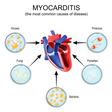 Miyokardit. İnsan kalbinin çapraz kesiti ve Protozoa, Bakteri, Parazit, Mantar, Virüs gibi hastalıkların en yaygın sebepleri. Vektör çizimi. Şematik şema. Ayrıntılı poster.