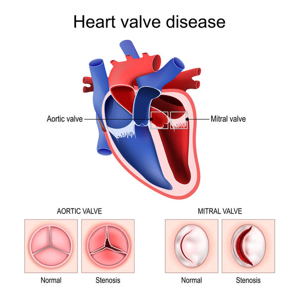 Heart valve disease. Cross section of human heart. Close-up of Mitral and Aortic valve. Healthy valve and Stenosis. Valvular heart disease. Vector. Schematic diagram. Detailed poster.