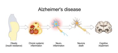 Alzheimer hastalığı ve insülin direnci. Bilişsel çöküş. Obeziteden, kronik sistemik iltihaplanmadan nöroiltihap ve bilişsel bozukluktan nöronların ölümüne kadar. Vektör. Şematik şema. Ayrıntılı poster.