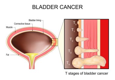 Mesane kanseri aşamaları. İnsan idrar kesesinde kaplama, bağ dokusu ve kas gibi katmanlar var. İdrar kesesi duvarındaki tümörlere yakın çekim. Kanserin T aşamalarını gösteren diyagram. Malignant Tümörlerinin TNM Sınıflandırması. Vektör illu
