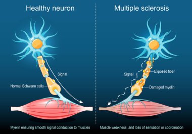 Çoklu skleroz. Myelin, sağlıklı nörondaki kaslara düzgün bir sinyal iletimi sağlıyor. Multiple skleroz nöron hasarlı miyelin, açığa çıkmış lif. Kas zayıflığı, duyum kaybı ve koordinasyon kaybı. Isome illüstrasyon. Vektör posteri