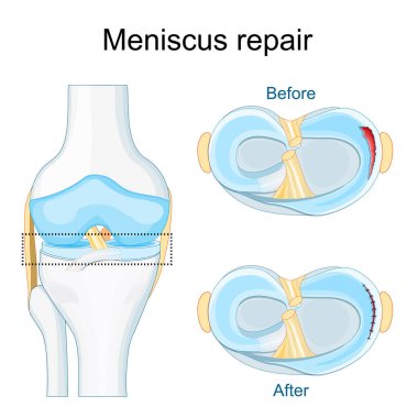 Meniscus injury. Close-up of knee joint. Meniscal tear before and after surgery. Suture repair. Meniscal healing. Top view of a human knee. Vector poster clipart