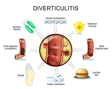 divertikülit ilerleyişini tetikliyor. Gastrointestinal peristaliz ve kronik kabızlık. Gut hareketlilik bozuklukları. Diverticula, Kanama ve İltihaplanma ile kalın bağırsağın bir kısmına yakın çekim. İltihaplı tetikleyiciler. Vektör illüstrasyonu