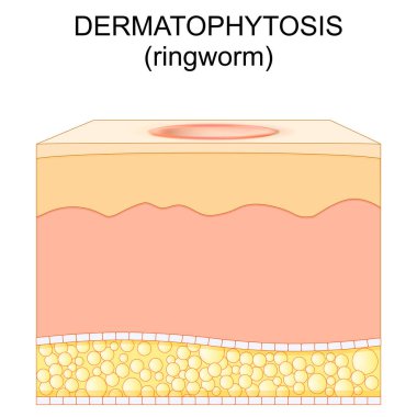 Dermatofizozis. Mantar derisi enfeksiyonu. İnsan derisi ile Kurtçuk 'un kesiştiği yer. Keratinophilik mantarlar. Deri erimesi. Vektör illüstrasyonu