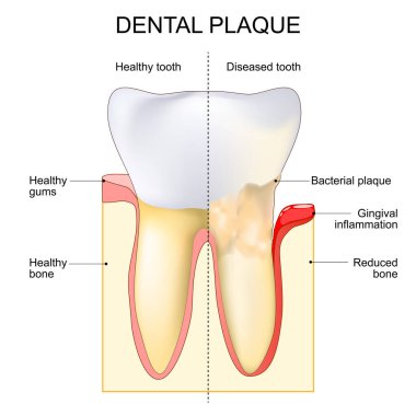 Diş plaketi. Bakteriyel plağın yanında diş eti iltihabı. Sağlıklı diş ve hastalıklı diş. Kariyer düzeni. Periodontal hastalıklar. Ağız biyofilmi. Dişlerin bakteriyel kolonileşmesi. Dişeti iltihabı. Vektör illüstrasyonu