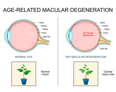 Maküler dejenerasyon. Yaşla ilgili kuru maküler dejenerasyon. AMD. İnsan gözünün çapraz kesimi. Merkezi görme kaybı. Bir macula, optik disk, koroid, retina, sklera ve fovea yakın çekim. Vektör posteri