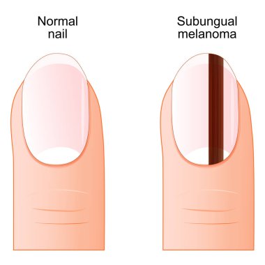 Dil altı melanom. Tırnak altında melanom. Tırnak kanseri olan bir insan parmağının yakın çekimi. Vektör posteri