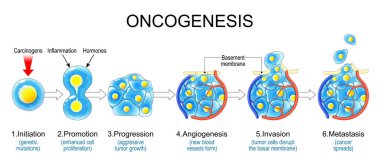 Carcinogenesis. Oncogenesis stages. Normal cells are transformed into cancer cells. Process of tumorigenesis. genetic and epigenetic mutations, abnormal cell division, Cancer development, tumor spreads and Metastasis. Vector poster clipart