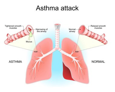 Astım krizi. Akciğerler, bronşlar ve hava yolları. Normal bir hava yolunun kesitini yakın çekim ve mukus ile bronşol darlığı. Astım belirtileri. Bronkospazm sırasında kaslar gerilmiş. Ciğerlerde iltihaplı solunum yolları hastalığı. Ve