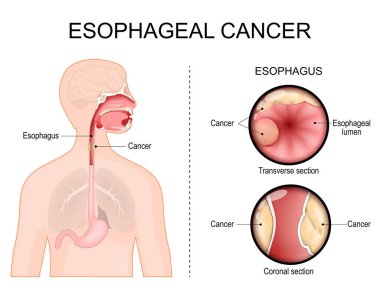 Özofagus kanseri. Esophagus 'un enine kesiti ve koronal bölümü. Adenokarsinom. Esophageal Lumen 'ın yakın çekimi. Midesi, boğazı ve yemek borusu olan insan silueti. Vektör çizimi. Tıbbi poster