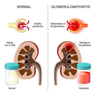 Glomerulonefrit. Böbrek iltihabı. Glomerulus 'a yakın çekim. Böbrek hastalığı. İnsan böbreklerinin kesiti. Sağlıklı idrar ve hematüri olan konteynırlar. Vektör çizimi. Tıbbi poster