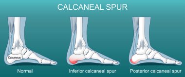 Kalkaneal çıkıntı. Kalkaneusun arka ve alt kısımlarında osteofitler var. Topuk dürtüsü. Plantar fasiiti. Aşil tendinopati. Topuk ağrısı. Ayak biyomekaniği. Osteofit formasyonu. Plantar fasya ve aşil tendonu. Vektör posteri. Isometric 