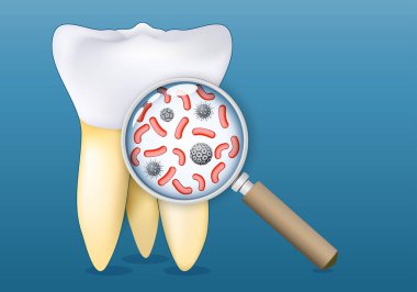 Tooth and a magnifying glass that zooming in to bacteria and microorganisms present on the surface. Tooth decay. Bacterial biofilms and dental diseases, like cavity, dental plaque, gingivitis. Importance of oral hygiene and preventive dental care. Ve clipart