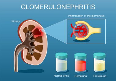 Glomerulonefrit. İnsan böbreğinin enine kesiti. Glomerulus iltihabına yakın çekim. Normal idrar, Proteinuria ve hematüri ile test tüpü. İdrarda kan var. Vektör posteri. Isometric düz illüstrasyon