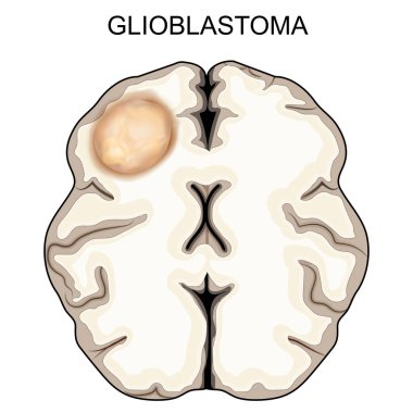 Glioblastoma. Brain tumor. Malignant cancer. Vector illustration clipart