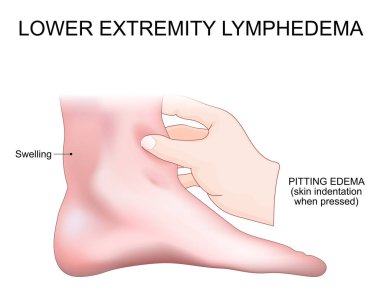 Alt ekstremite lenf kanseri. Lenfoödem belirtileri ve belirtileri. Lenfatik tıkanıklık. Kronik ödem oluşumu, şişkinlik ve dokularda sıvı birikmesi. Meiges hastalığı. Vektör illüstrasyonu