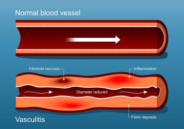 Vaskülit. Otoimmün hastalık. Sağlıklı kan damarı ve damar hasarı. Enflamasyon, fibrin kalıntıları ve Fibrinoid nekrozu azaldı. Vektör illüstrasyonu.