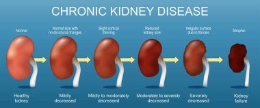 Kronik böbrek hastalığı. CKD 'nin sağlıklı böbrekten Glomerular filtreleme oranına ve böbrek yetmezliğine geçiş aşamaları. Vektör illüstrasyonu.