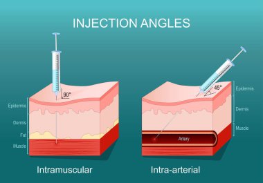 Enjeksiyon açıları. Şırınga ve iğneyle insan derisinin çapraz kesimi. Atardamar içi ve kas içi enjeksiyon. Vektör çizimi. Tıbbi diyagram.