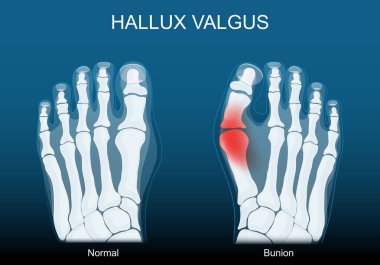 Nasır. Hallux valgus. Ayak deformasyonu. Ayak parmağı uyumsuzluğu. Tıbbi şema. Vektör illüstrasyonu