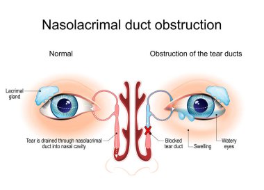 Nasolacrimal kanal tıkanıklığı. Dacryocystitis. Gözyaşı kanallarının kesiti. İnsan gözü anatomisi. Epifora. Tıbbi şema. Vektör illüstrasyonu