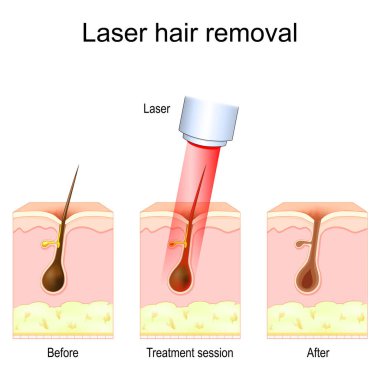 Lazer tüy aldırma. İnsan derisi ve saç folikülünün kesiti. Vektör çizimi. Tıbbi diyagram.