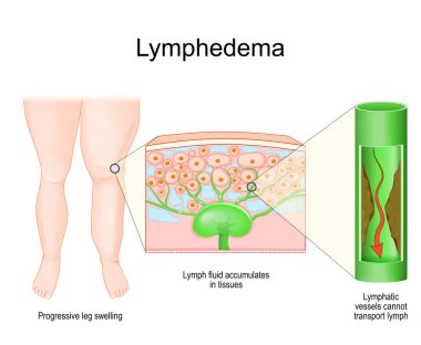 Lenf kanseri. Bacağında şişlik var. Derinin lenf nodu ve dokularda biriken sıvıyla çapraz kesiti. İnsan lenfatik sisteminin bir parçası. Lenf taşıma kapasitesi olmayan lenfatik damarlara yakın çekim. Vektör çizimi. Tıbbi poster. Sche.