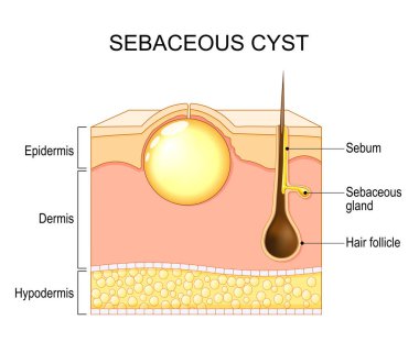 Kıl folikülünden oluşan bir yumru. Wen. Pilar kist. Trichilemmal kist. Sebaceous kisti. Vektör çizimi. Tıbbi poster. Şematik diyagram