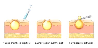 Yağlı Kist Çıkarma Adımları. Lokal anestezi enjeksiyonu, büyümenin üzerinde küçük bir kesik ve tam kapsül çıkarma. Küçük bir delikten epidermal veya pilar kistlerin en az invaziv çıkarılması. Trichilemmal kist çıkarma. Vektör illüstrasyonu