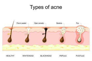 Sivilce tipleri. Sağlıklı cilt, Kır Saçlı ve Siyah Kafalar, Papules ve Kabarcıklar. Vektör çizimi. Tıbbi poster. Şematik diyagram