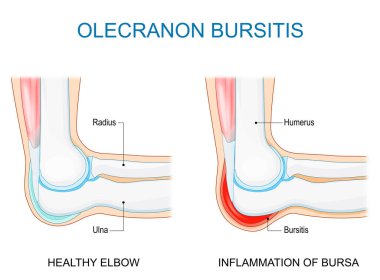 Bursitis. İnsan dirseği iltihabı. Olecranon, bursa kesesi, pazı kemiği, dirsek kemiği ve dirsek kemiğiyle birleşmiş. Eklem ağrısı. Vektör çizimi. Tıbbi poster. Şematik diyagram