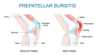 Predizellar bursitis. Diz eklemi iltihabı. Vektör çizimi. Tıbbi poster. Şematik diyagram