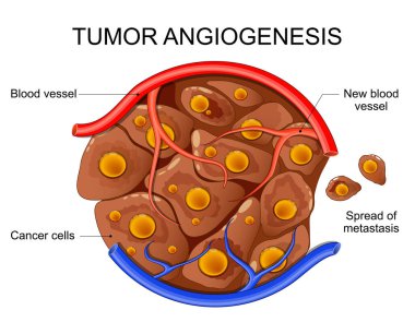 Kanser hücre gelişimi ve metastaz. Tümör anjiogenezi. Vektör çizimi. Tıbbi poster. Şematik diyagram