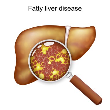 Yağlı karaciğer hastalığı. Hepatik steatoz. Büyüteç altında, karaciğerde hücreler ve aşırı yağ birikiyor. Şema çizimi. Tıbbi şema. Ayrıntılı Vektör posteri. 