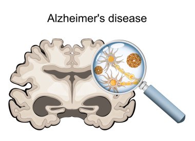 Alzheimer hastalığı. Nörodejenerasyon. Alzheimer beyninin enine kesiti, serebral korteksin Atrofi, genişlemiş ventriküller ve Hipokampüs. Büyüteç altında, nöronların mikroskobik görüntüsü nörofibrilasyon karışıklıklarını ve amiloit plaklarını gösterir.
