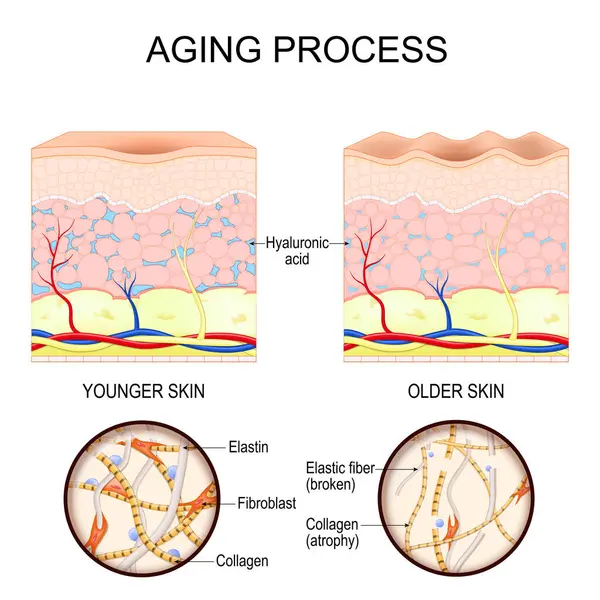 Yaşlanma süreci. Daha genç ve daha yaşlı. Kolajen, elastin lifleri ve fibroblastlar yakın çekim. Ciltteki yaşla ilgili değişiklikler arasında kolajen fiber atrofisi, elastin bozulması ve hyaluronik asit tükenmesi yer alıyor. Ayrıntılı Vektör posteri