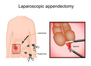 Laparoskopik ameliyat. İltihaplı bir apandisti almak için apandisit ameliyatı. Minimum invaziv ameliyat. Apandisit ameliyatı. Ayrıntılı Vektör posteri