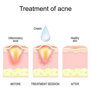 Tedavi öncesi ve sonrası sivilce iltihabı veya Topik akne tedavisi prosedürü. Sivilce tedavi kremi. Dermatoloji diyagramı. Ayrıntılı Vektör posteri