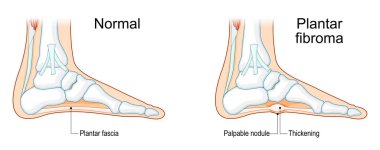 Plantar fasiyal fibromatoz. Plantar fibroma. Deri hortumları hastalığı. Morbus Ledderhose. Ayak iskeleti. Kemiklerin orta kısmı ve plantar fasya ile kötü huylu olmayan bağ dokusu kalınlaşması. Ayrıntılı Vektör posteri