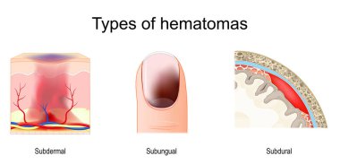 Hematom tipleri. Tırnağın altındaki parmak ya da ayak parmağındaki hematom. Derinin altında deri altı lokal kanama var. Dura mater ve araknoid mater arasında bulunan subdural hematom. Vektör illüstrasyonu