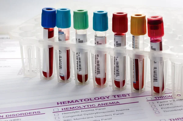 分析のための血液検査サンプルチューブのコレクションを持つ実験室トレイ 血液学研究室の患者からの血液サンプルを持つ管のラック — ストック写真