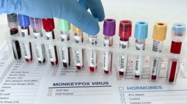 Doktor laboratuvarda maymun çiçeği testinin analizi için kan örneği tüpü tutuyor. Maymun Çiçeği virüsü testi için kan testi yapan laboratuvar teknisyeni ya da doktor.