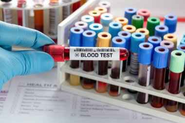 Laboratuvarda analiz etmesi için kan testi tüpü olan bir doktor. Teknisyen hematoloji laboratuarında kan örneği tüpü tutuyor.
