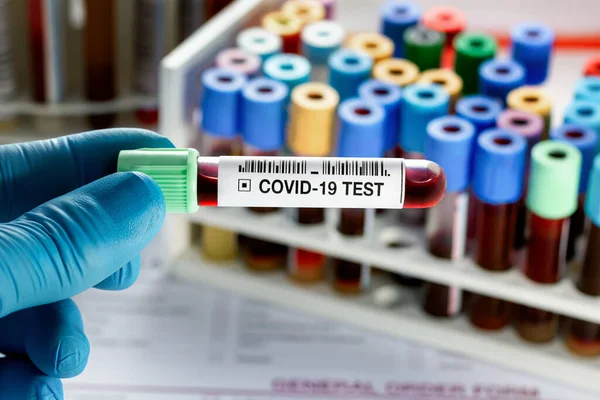 Egy Technikus Laborban Vérvizsgálattal Orvos Kezében Vérminta Cső Covid Diagnózis — Stock Fotó