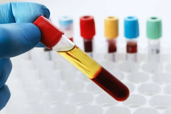 从化学实验室分离血清的病人身上提取的血液 离心分离后保存血样试管的实验室技术人员 — 图库照片