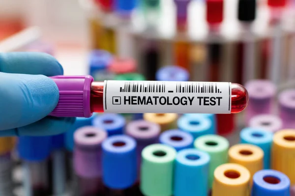 Blut Eines Patienten Zur Diagnostik Hämatologielabor Labortechniker Hält Blutröhrchen Test — Stockfoto