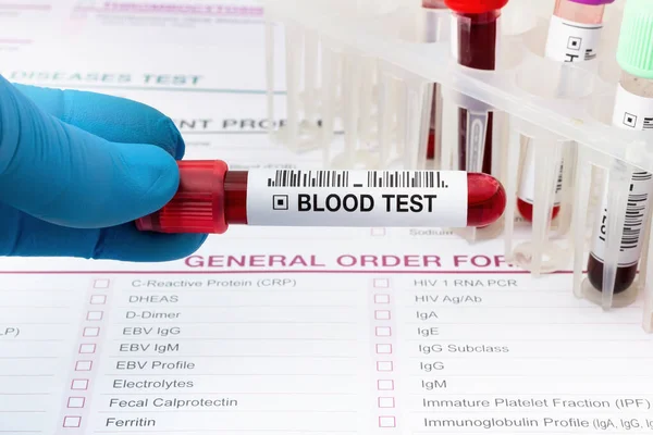 血液検査管のある医者が血液検査室で分析してる 血液学研究室で分析のための血液サンプル管を保持する技術者 — ストック写真